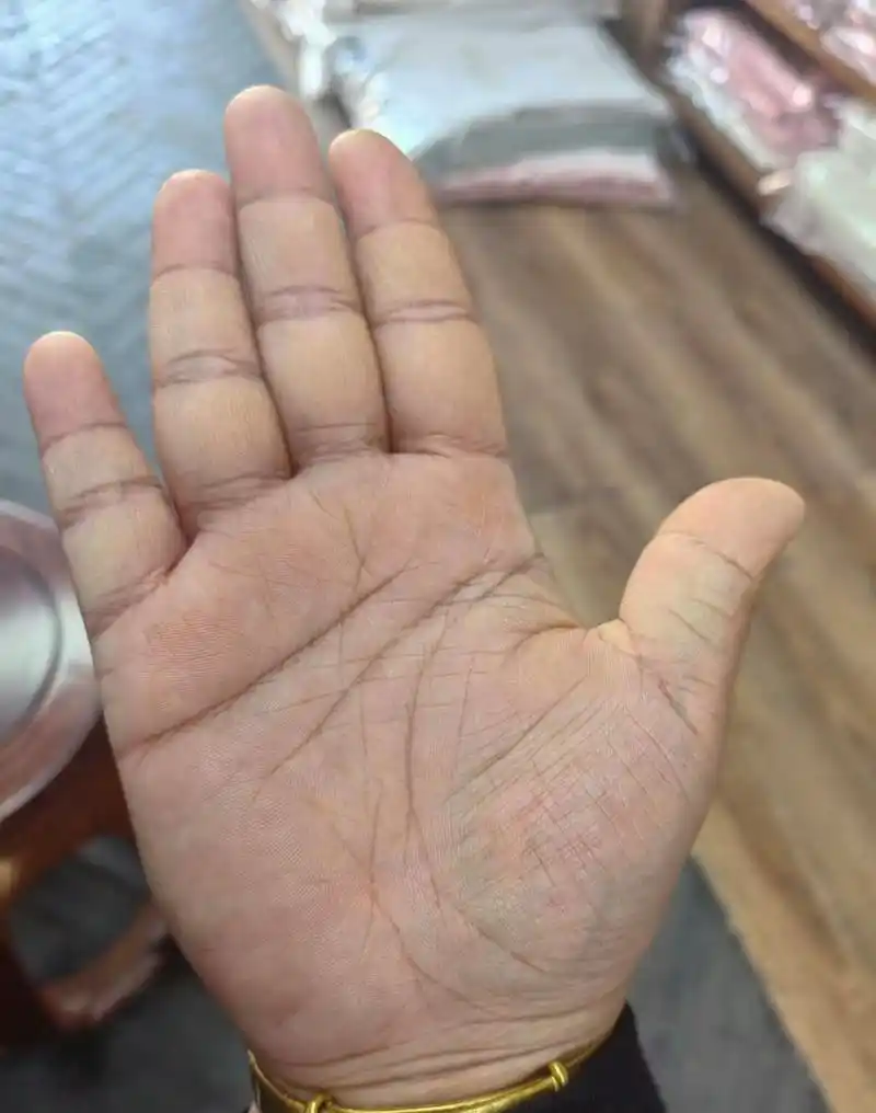 川字纹,手掌过于肥厚,加上生命线断开,说明你人极容易生病,极容易出