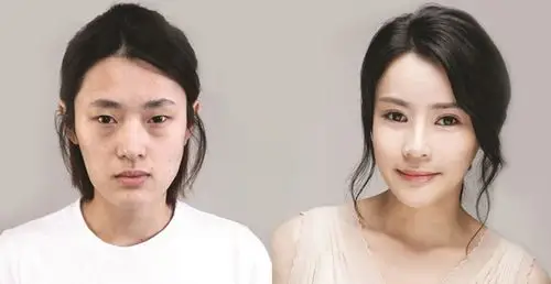 女模特3次整形8项手术全过程曝光图