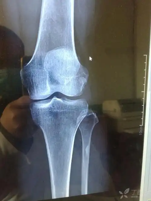 患者女,以前磕碰了一下,昨天疼痛,今天来就诊.