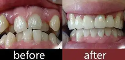 牙齿矫正前后对比照片