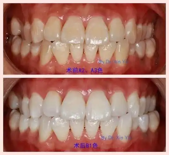 牙齿美白对比照