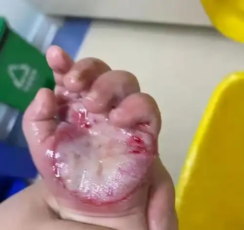 近期宝宝烫伤多发专家提醒这些处理要不得