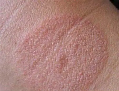 花斑癣早期图片 (30)_有来医生