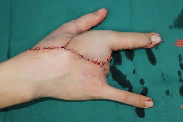 一例手指再造手术,不仅拯救了少年的前途,更鼓舞了上千患者