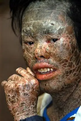 盘点世界最恐怖的怪病(胆小者勿看!)— 未解之谜网