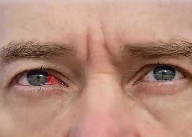 散瞳 会"伤害"眼睛吗?瞳孔散大会不会导致青光眼?-常青藤健康网