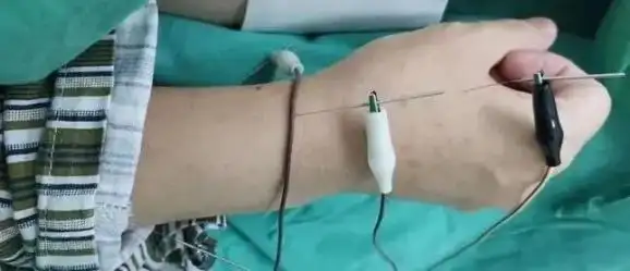 针刺复合麻醉体外循环下的心内直视手术,拥有丰富的针刺麻醉手术经验