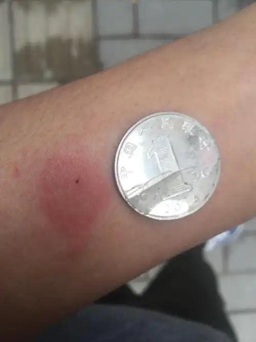 ppd实验 第三天下午的结果 晚上又去喝酒 这是肺结核吗?