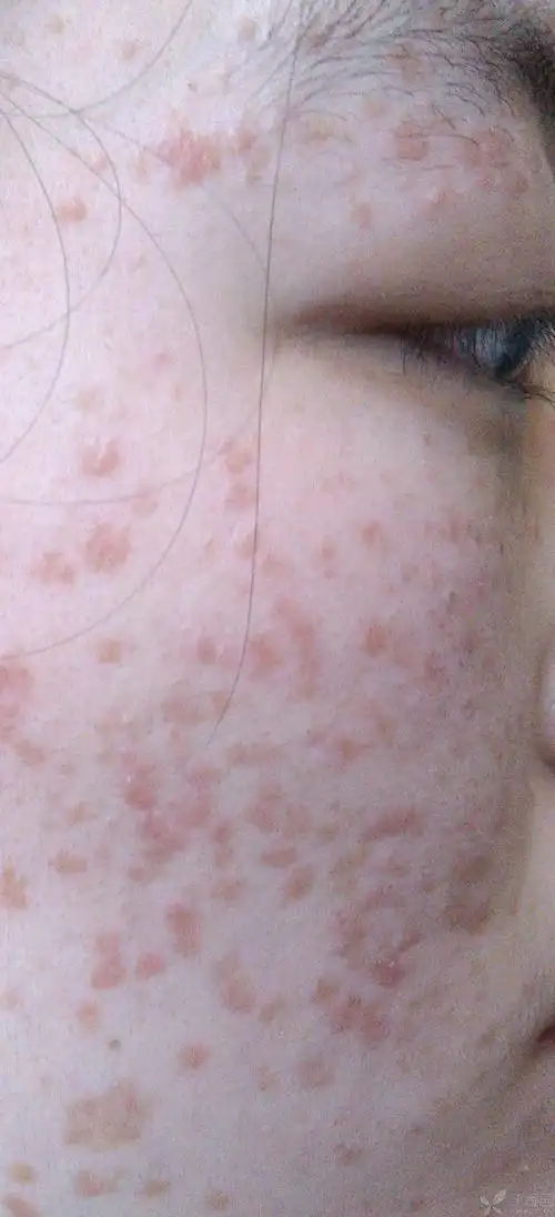 【原创】严重的扁平疣,服中药1月痊愈