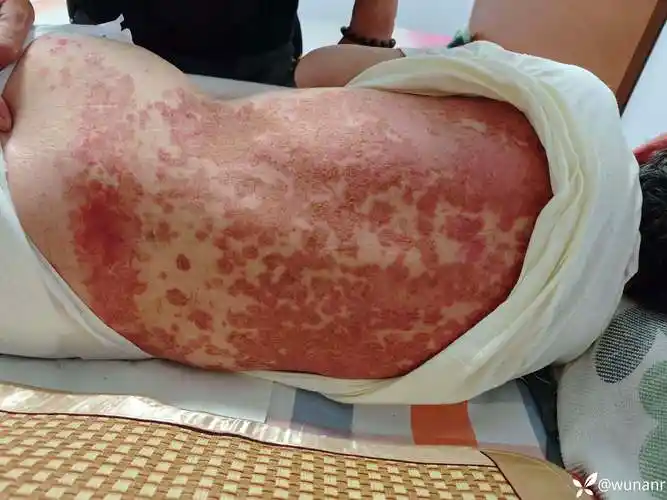 求助|脑梗卧床老年病人后背大面积皮肤红疹