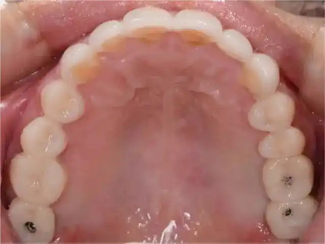 口腔美学设计为全口重建咬合健康大讲堂第50期