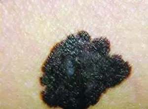 痣细胞,痣细胞的原因,痣细胞怎么办-皮肤性病科-皮肤科-症状查询-寻医