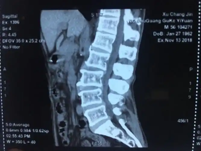 《经皮椎弓根钉通道扩张椎管减压椎间融合治疗腰椎管狭窄症》