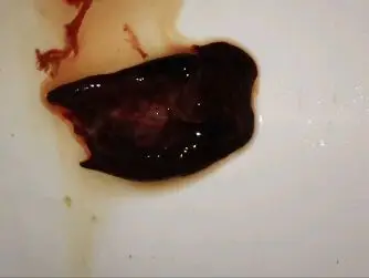 怀孕第七周流血四天,今天第五天还流血块,是不是以经流产了