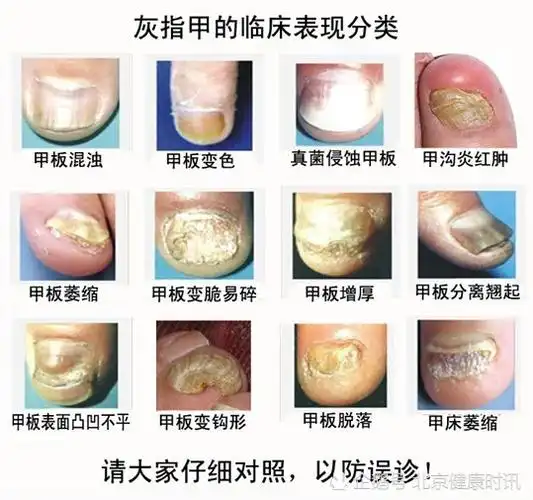 专家教你如何判断自己是不是灰指甲?