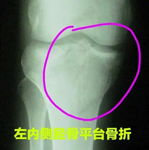 内侧胫骨平台骨折,是一种较大暴力引起的关节严重损伤,同时伴有沿重