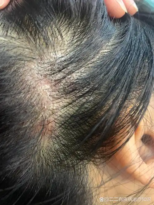 头皮出现红点点和头皮屑,痒!怎么办?