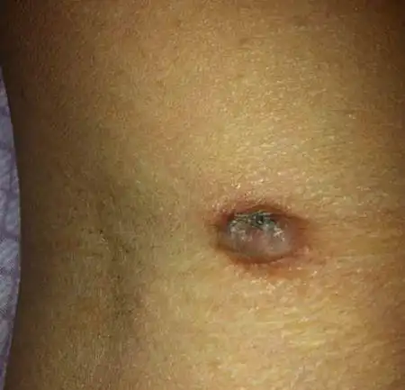 膝盖弯长了个硬疙瘩,长疙瘩的地方一受热就痛,会不会是肿瘤要怎么治.