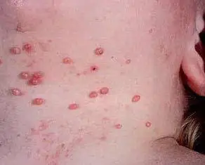 一般多发于女性30岁以上患者.