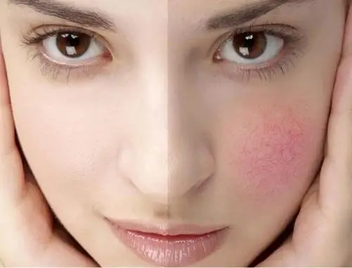 简单几招教你辨别自己属于哪一种敏感肌