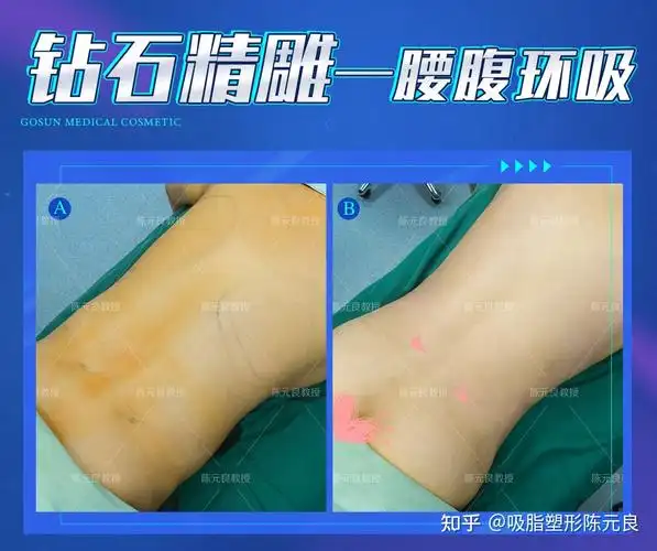 吸脂塑形陈元良 的想法: #钻石精雕# 腰腹环吸 背部吸脂#陈元良吸