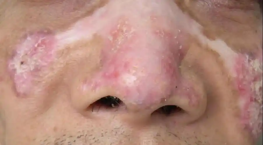 盘状红斑狼疮伴色素脱失