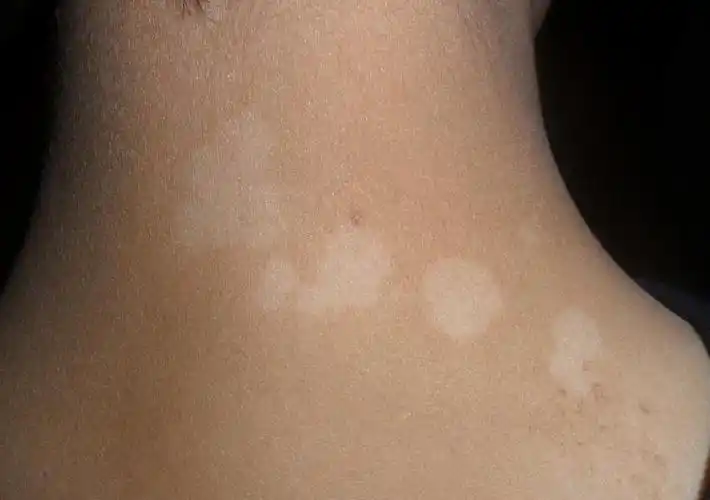 武汉青少年白斑如何治疗