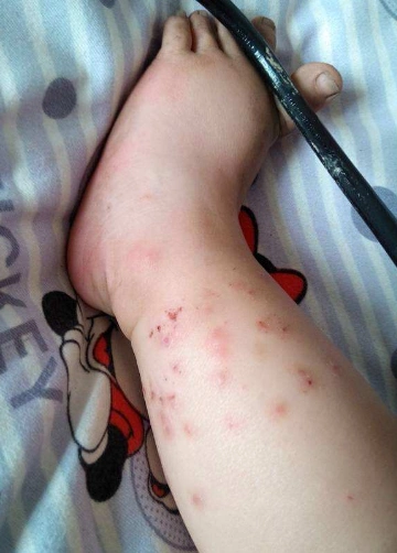 皮肤热毒图片 (30)_有来医生