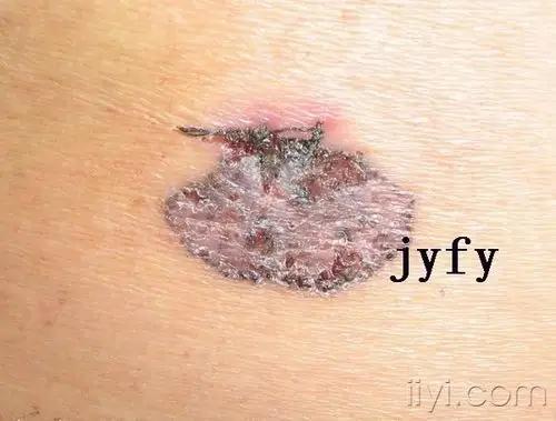 辞旧迎新3-基底细胞癌浅表型 - 皮肤及性传播疾病讨论版 - 爱爱医医学