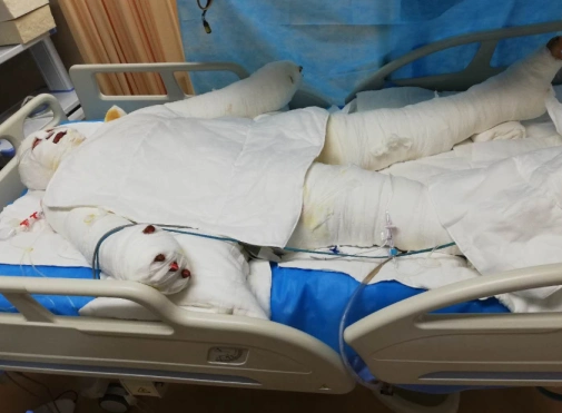 父爱如山花季少女全身烧伤父割皮救女谎称在外打工