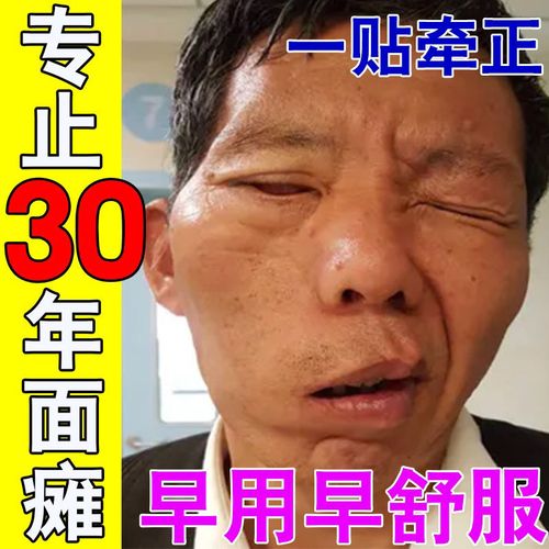 【面瘫后遗症专用】康复牵正面瘫后遗症面神经炎口眼联动嘴歪眼斜
