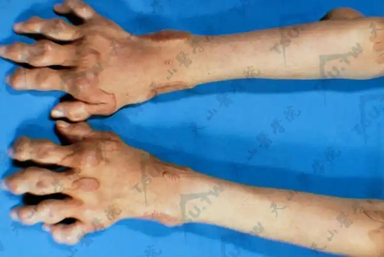 结节性黄瘤症状:扁平或隆起的圆形,黄或橘黄色结节,局限于关节伸面