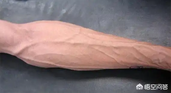 同学手臂上的血管凸出了如图,请问是哪的问题?