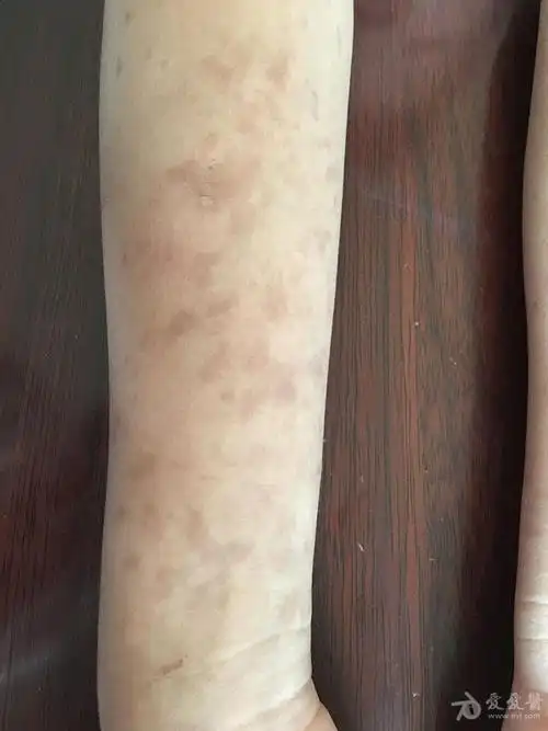 手臂散在咖啡色斑 - 皮肤及性传播疾病讨论版 - 爱爱医医学论坛
