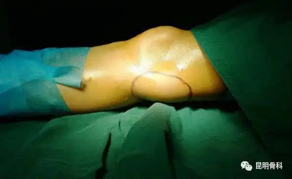 女患者膝盖长出鸡蛋大囊肿,昆骨医生:或与长期深蹲有关