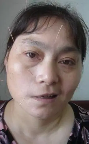面瘫可参考此医案