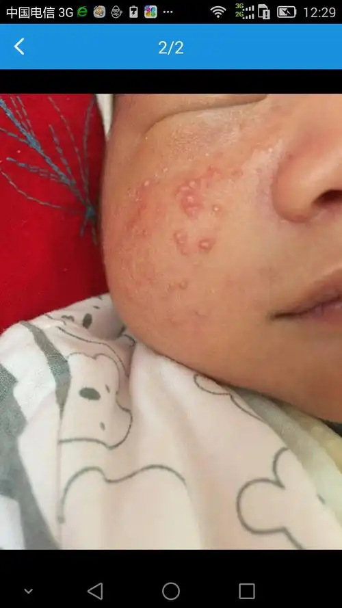 新生儿痤疮