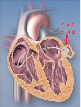 每个人的左心房边都有一个左心耳(laa, left atrial appendage).