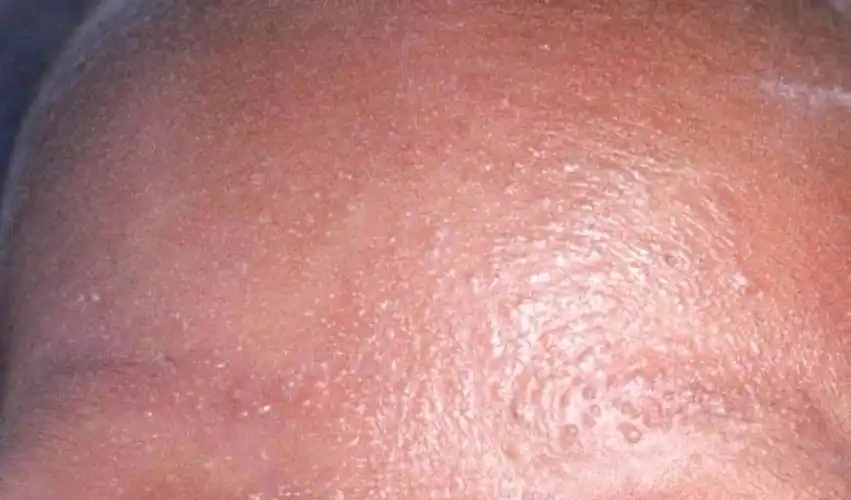 白痱,又称晶形粟粒疹痱子包括四种类型,白痱,红痱,脓痱,深痱.