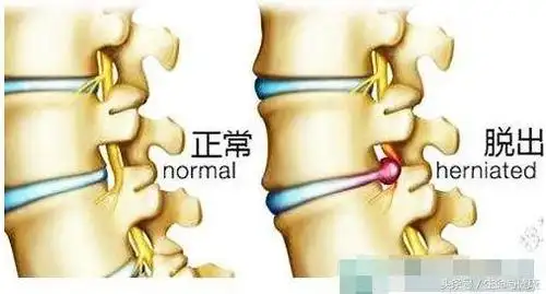 腰椎间盘突出症:保守还是手术?