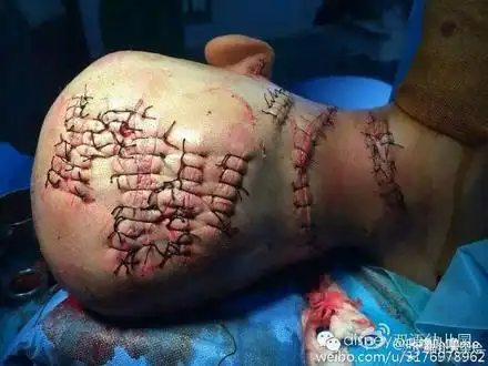 5岁男童被继母砍50多刀 右手手指被砍断