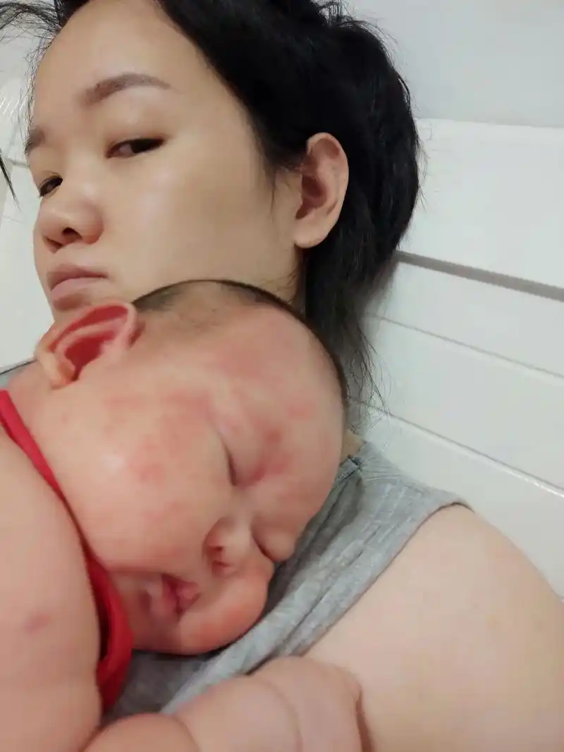 满月后脸上身上一直有红点和蜕皮,一直觉得是痱 - 抖音