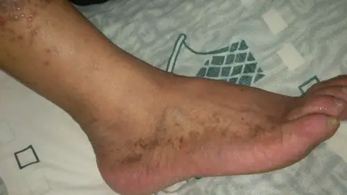 我爸爸脚上长了一大片深红色的斑.,很痒但是不疼.,长了有好几年了.