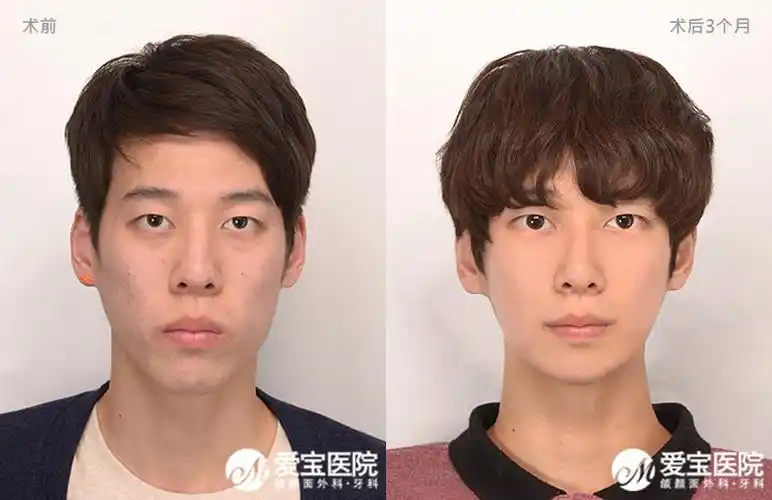 韩国做轮廓好的医院中爱宝属于什么水准