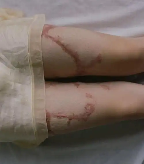 被富二代同学泼汽油烧伤女孩晒写真组图312