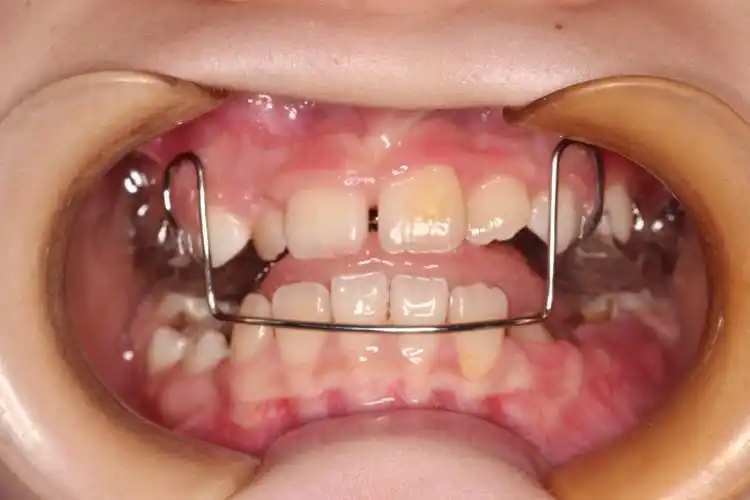 最勇敢的整牙小患者 3岁【地包天】