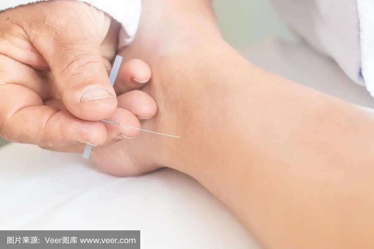在腿和脚上针灸