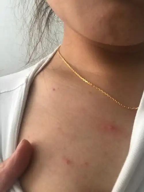 胸前总起这样的痘 ,露小白头.是怎么回事呀,起来自己消了 然后再起