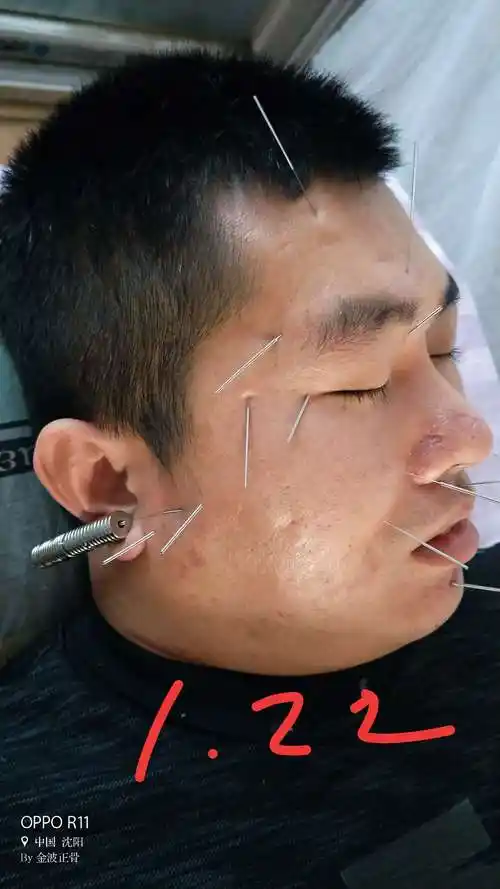 面神经麻痹针灸临床实践