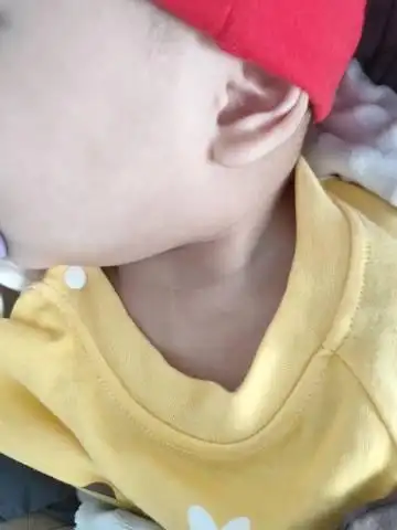 新生儿脖子下面有个凹进去的凹点,现在宝宝9个月变成了凸出来的白色